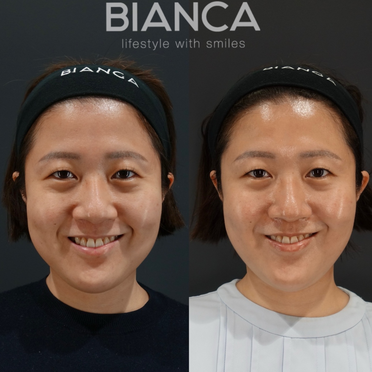 眉下フル（眉下切開＋ROOF切除＋上瞼脂肪取り）✖バッカルファット　施術１か月後
