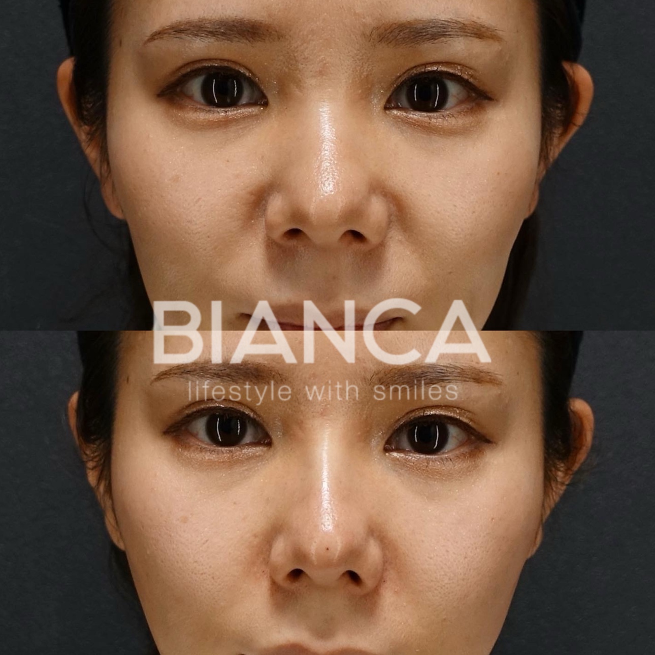 ヒアルロン酸 鼻注入（鼻翼基部 VOLUMA 1cc、頬コケ VOLUMA 1cc、鼻翼基部 VOLUMA 1cc）