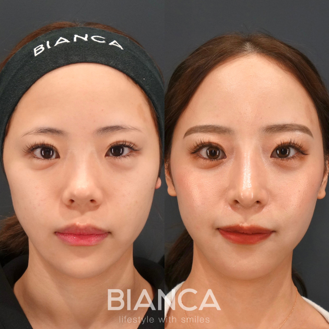 完璧に美しい鼻整形　鼻中隔延長術✖︎鼻尖形成✖︎オーダープロテーゼ✖︎ヒアルロン酸