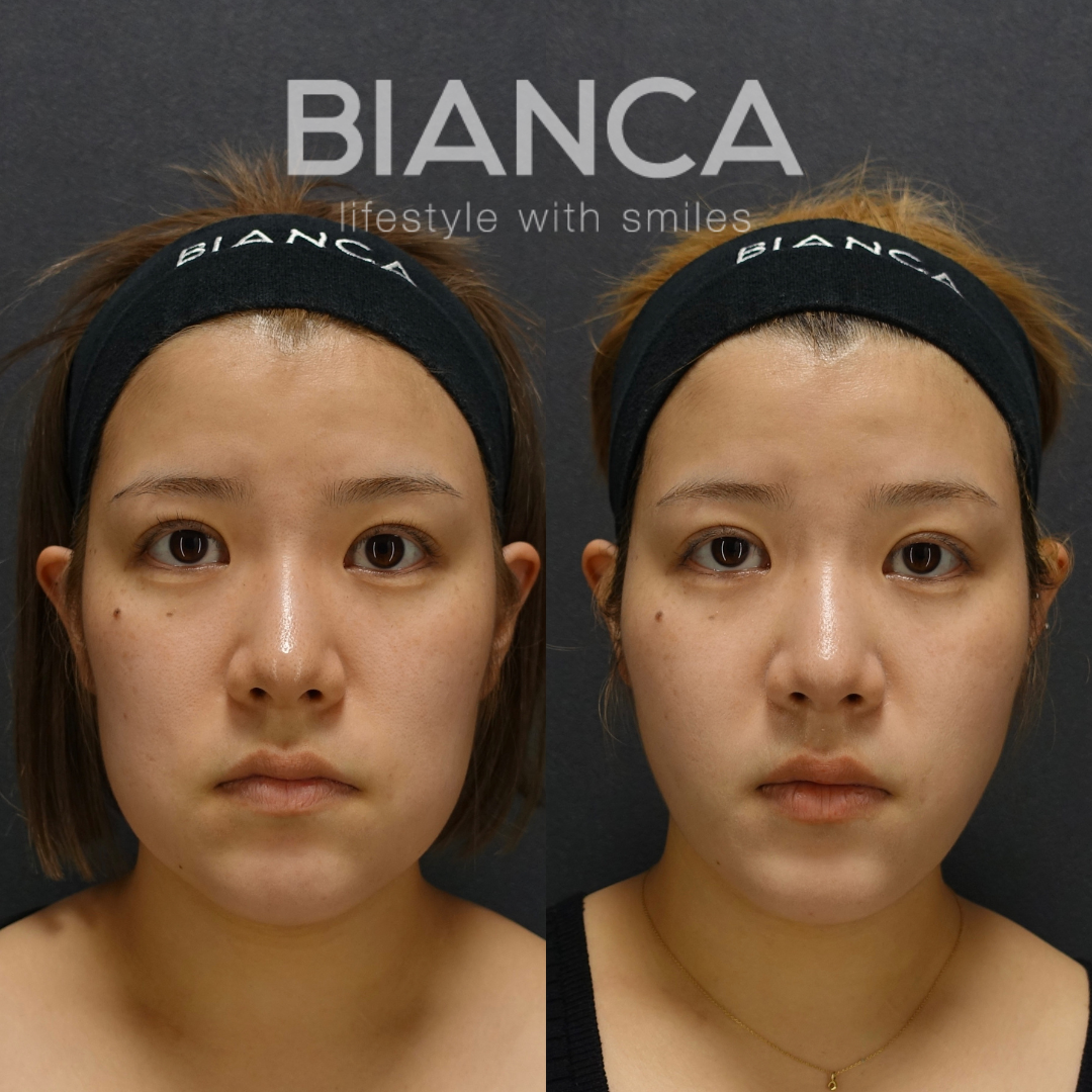 頬〜顎下の脂肪を除去し、たるみ予防で糸も併用　脂肪吸引(頬顎下)✖BIANCA LIFT 10本