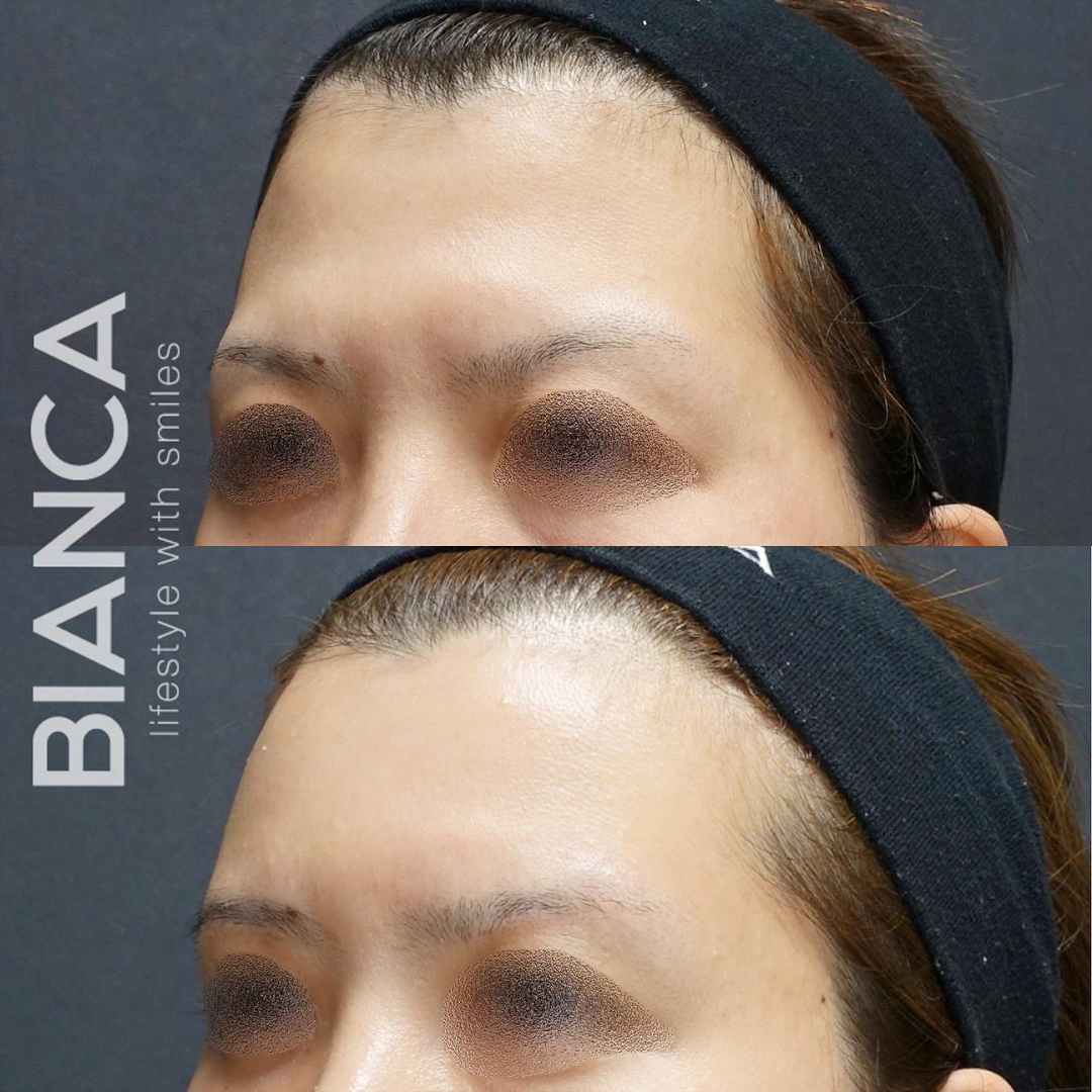 半永久的　額の脂肪注入