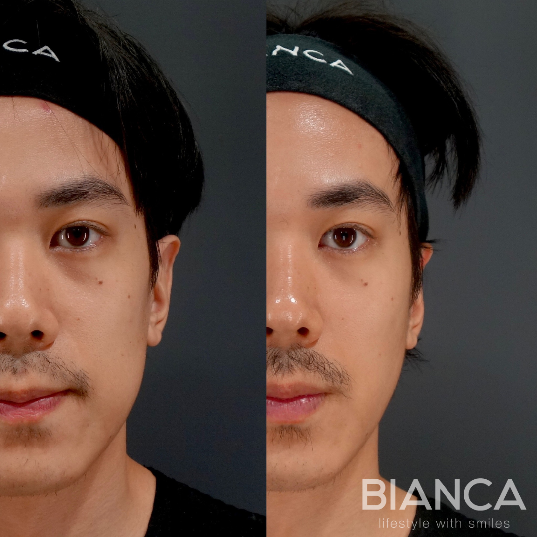 バッカルファット除去✖︎BIANCA LIFTで もたつきを改善