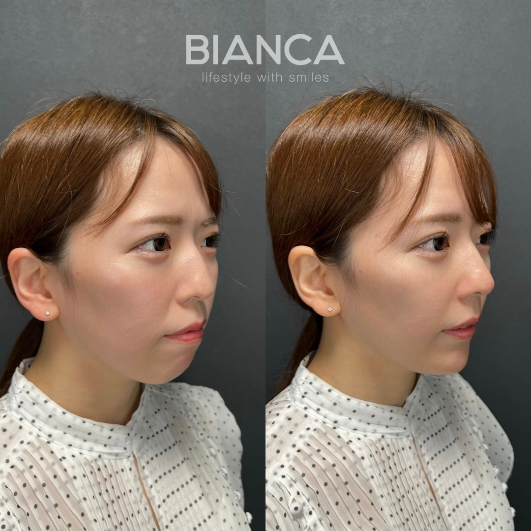 やりすぎず、自然だけど、変化はしっかり ヒアルロン酸(鼻、顎)