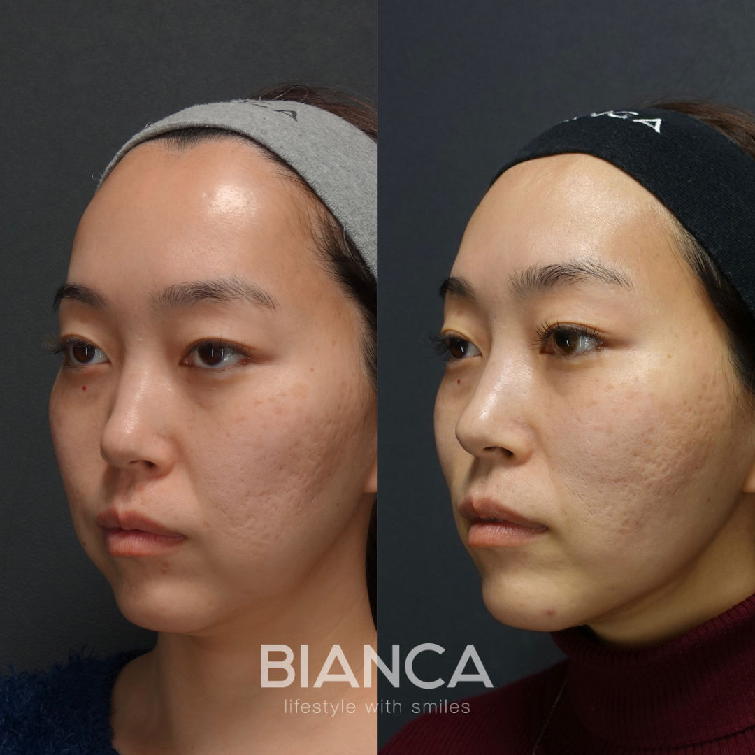 小顔フルカスタム (頬顎下脂肪吸引 ✖バッカルファット除去 ✖メーラーファット除去 ✖BIANCA LIFT10本 ⁡)