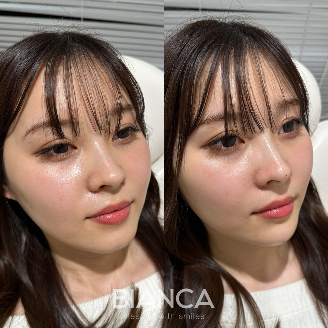 BIANCAクオリティ ヒアルロン酸(鼻先、鼻筋、顎、ほうれい線)