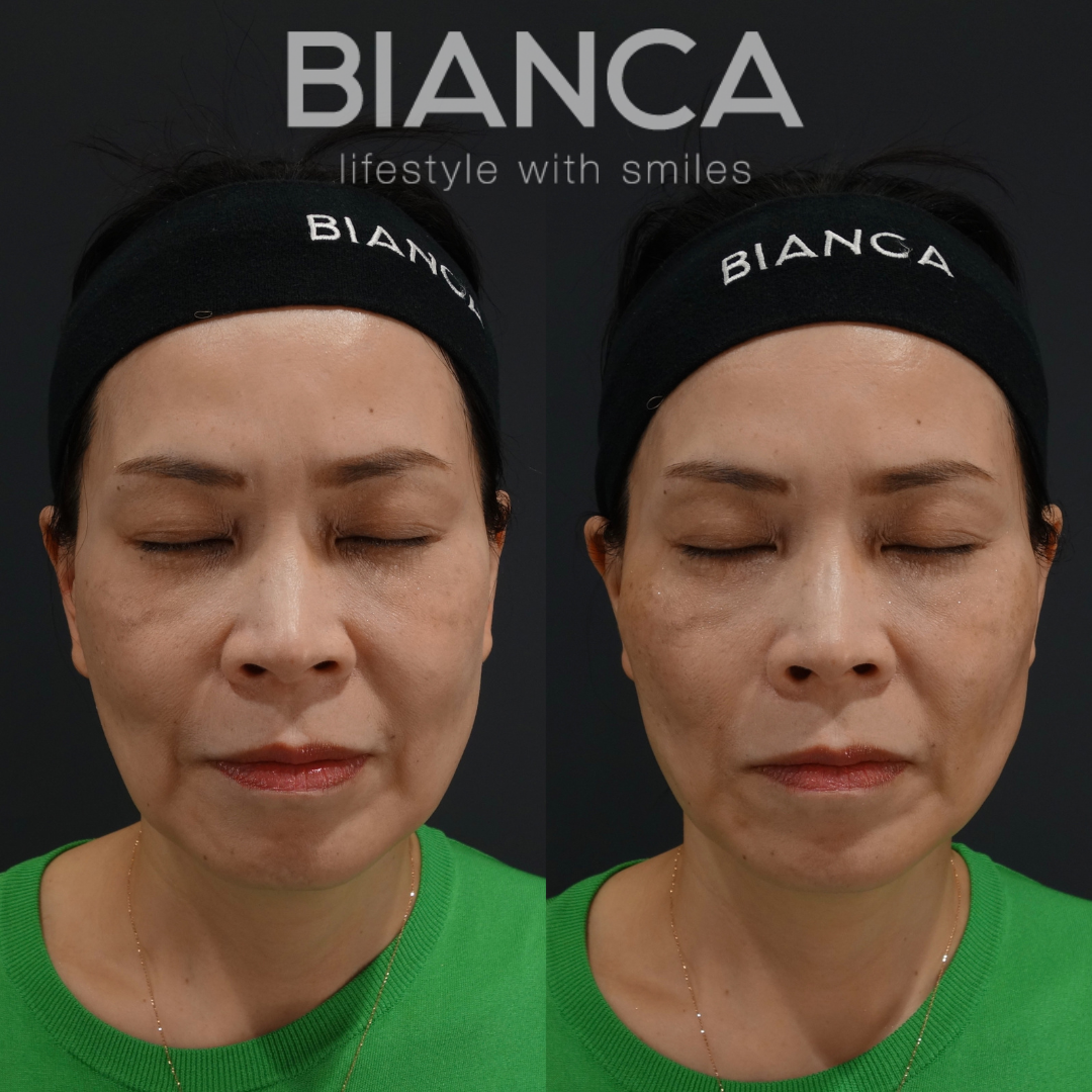 施術後でも全く違和感がない　BIANCALIFT 4本