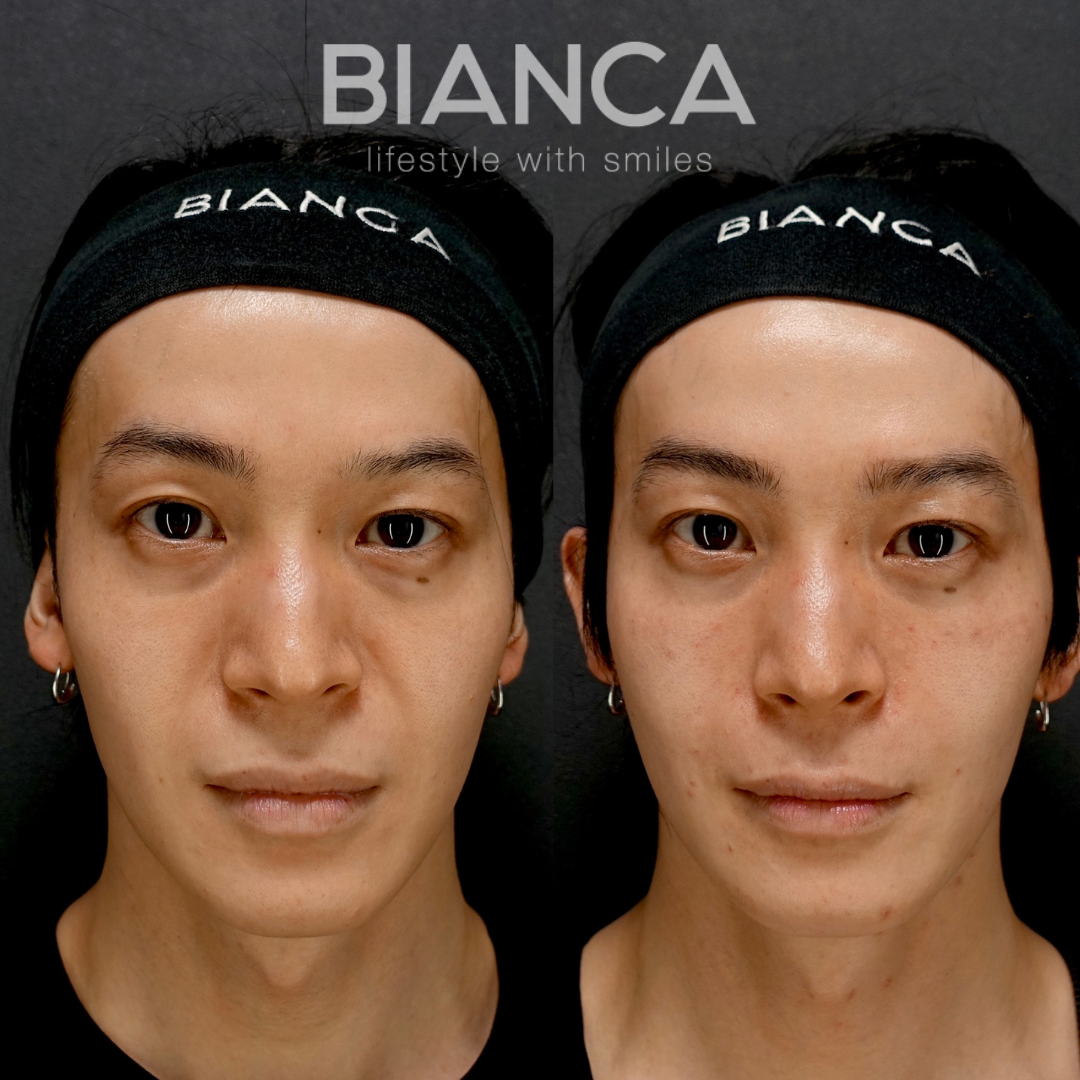 アンチエイジング治療 脱脂✖ヒアルロン酸(ゴルゴライン、ほうれい線、鼻翼基部)