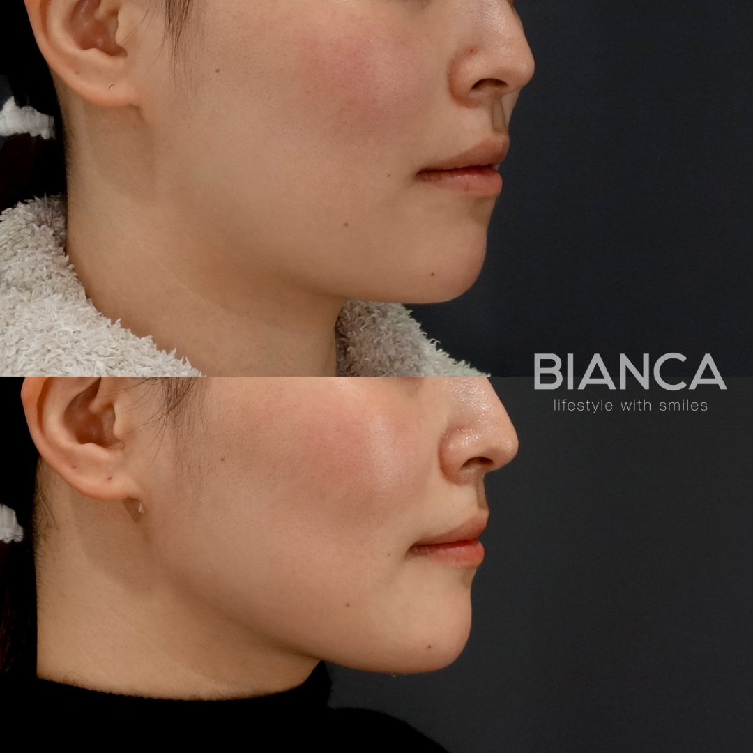 ベイザー脂肪吸引（顎下）✖BIANCA LIFT W