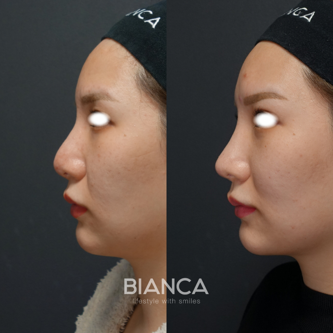 3度目のRhinoplasty (外鼻形成)