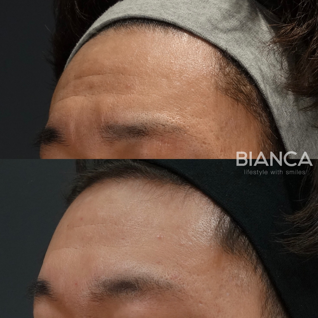 毛穴の開き、しわ、ニキビ跡を目立たなくしたい方にジュベルック