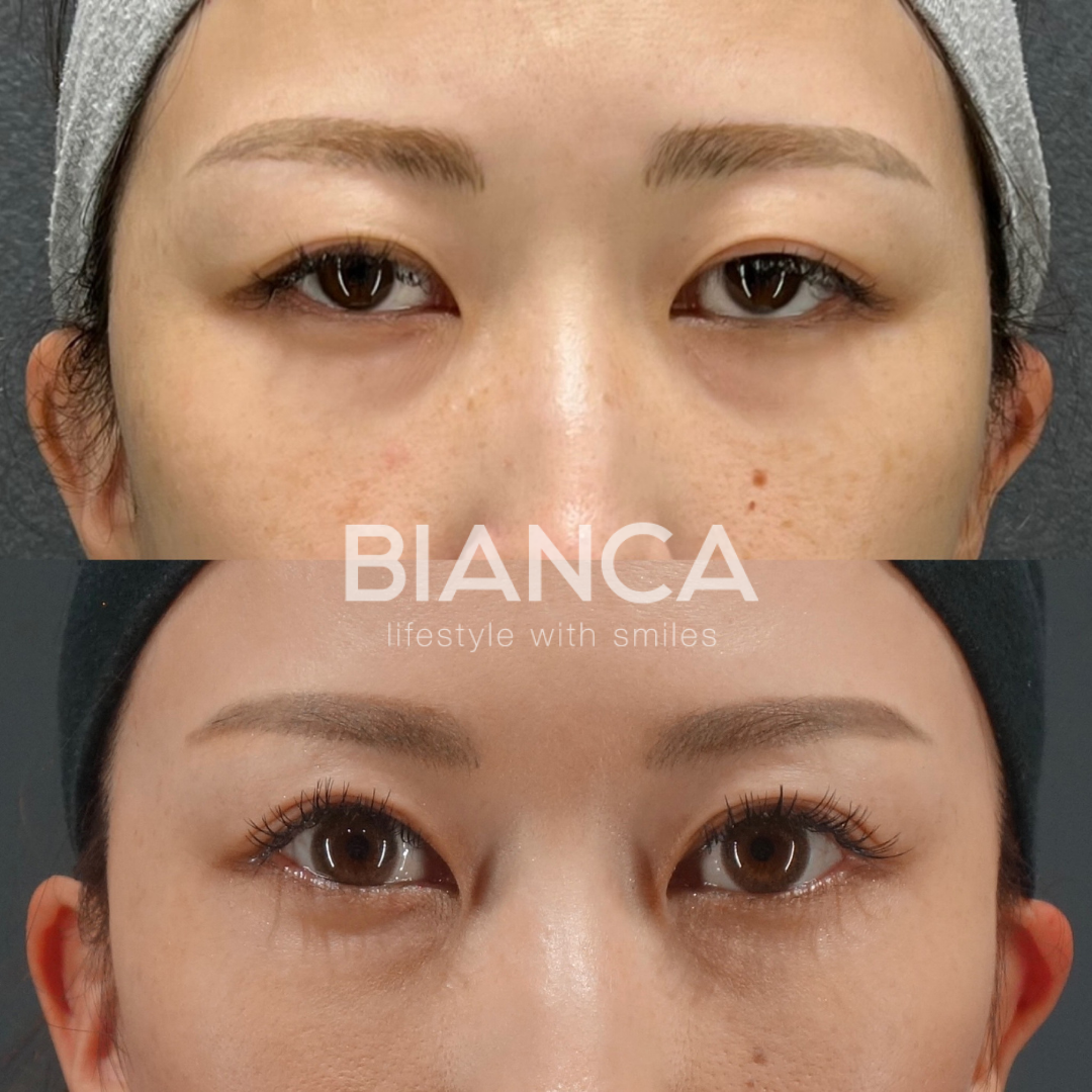 目の開きを改善　眼瞼下垂切開法