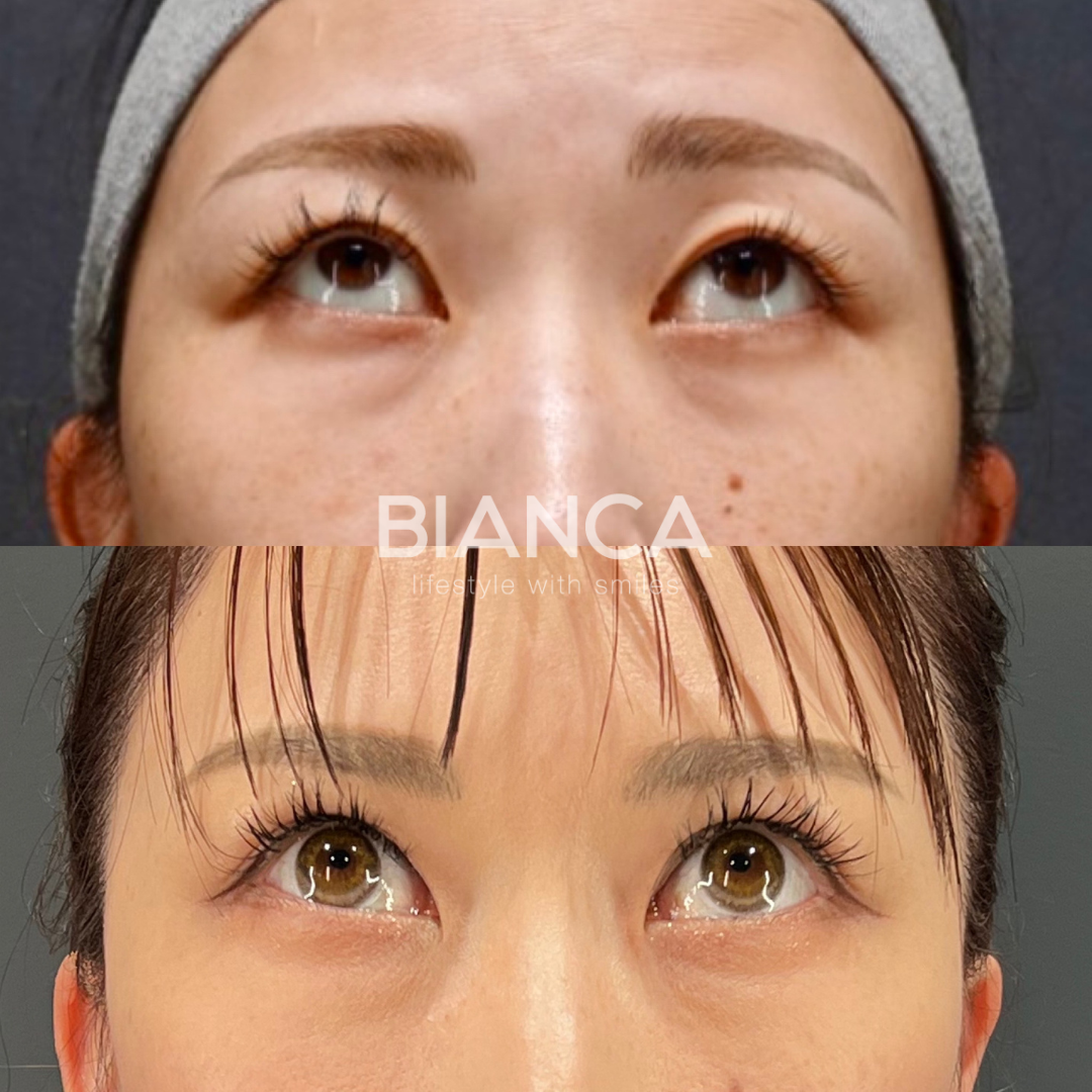 目の開きが悪く眠たそうなお目元を眼瞼下垂症手術で改善