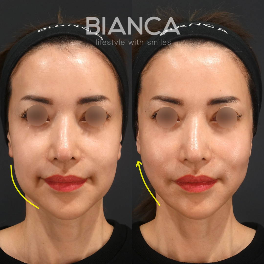 たるみ改善,小顔効果もあるBIANCA LIFT　6本