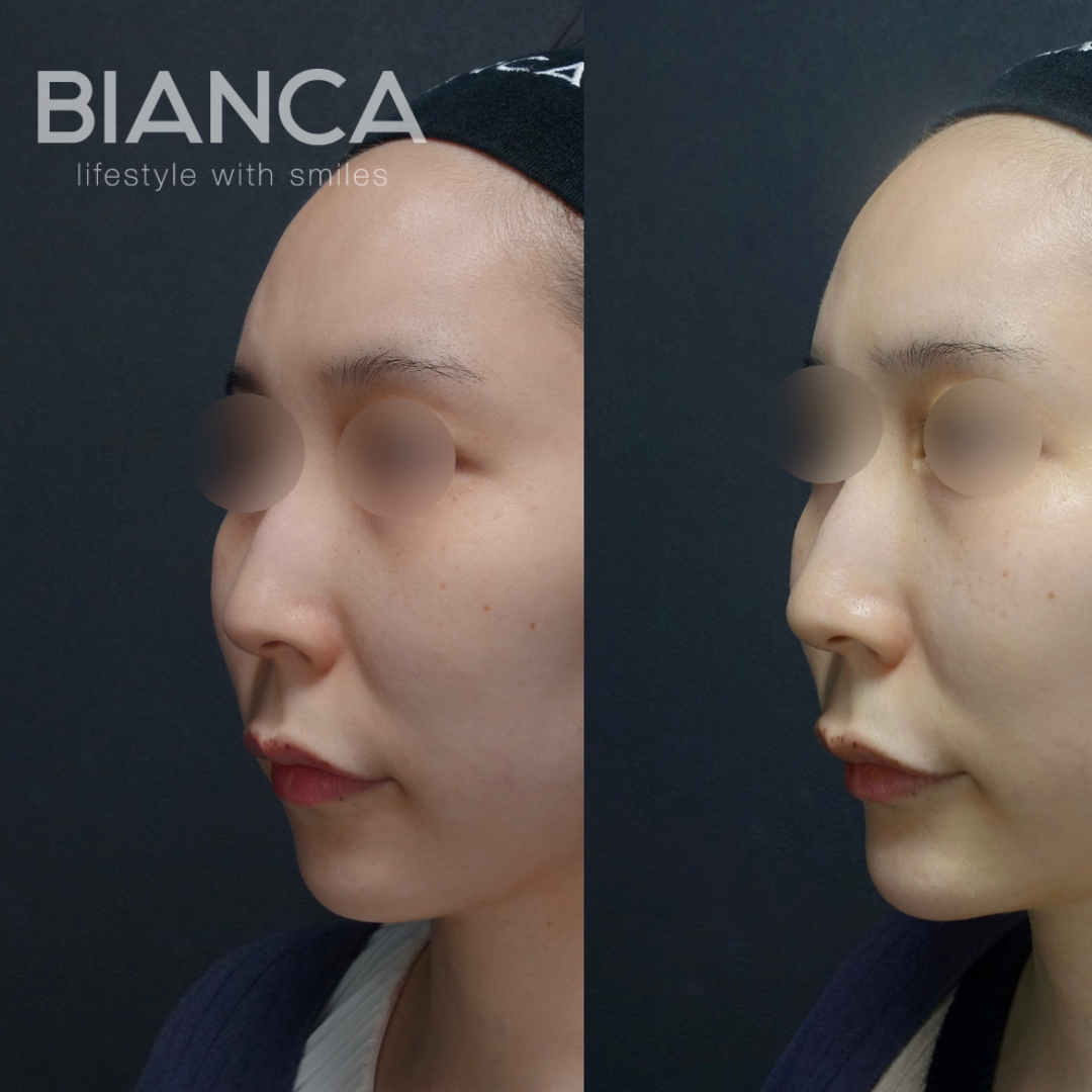 輪郭のバランスを整える　下顎プロテーゼ