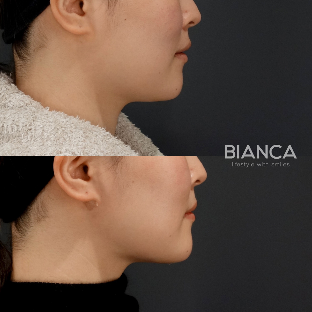 ベイザー脂肪吸引（顎下）✖BIANCA LIFT W