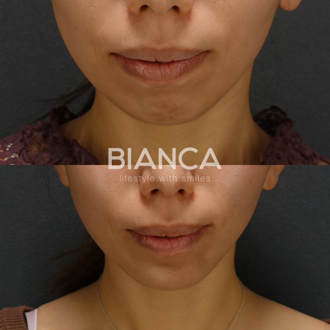 ボトックス注射（あご）、ヒアルロン酸注射（側頭部・頬・あご）BIANCA LIFT10本