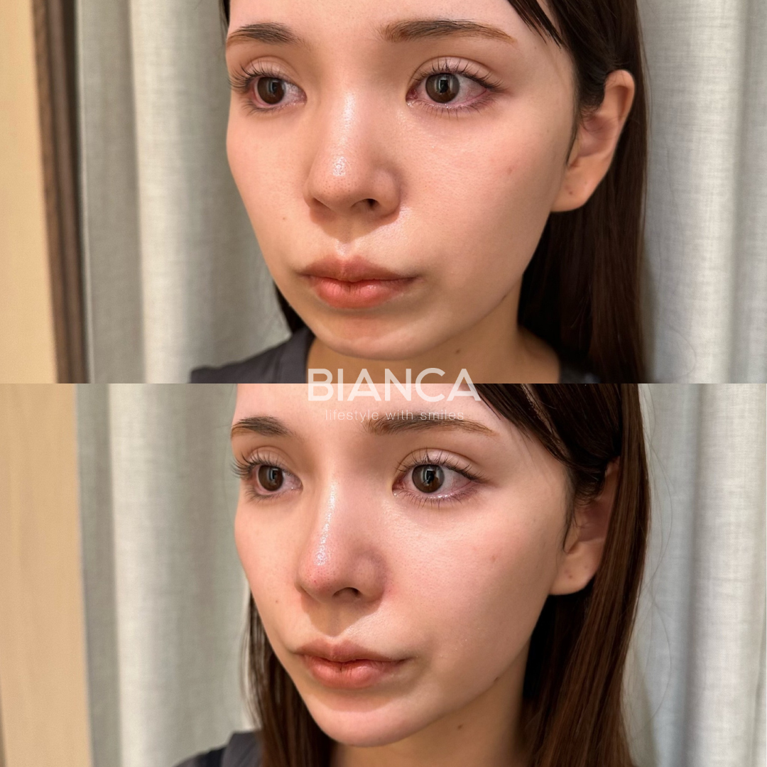 口元のバランスを整え自然な垢抜け ヒアルロン酸(鼻先、鼻筋、ほうれい線、顎)