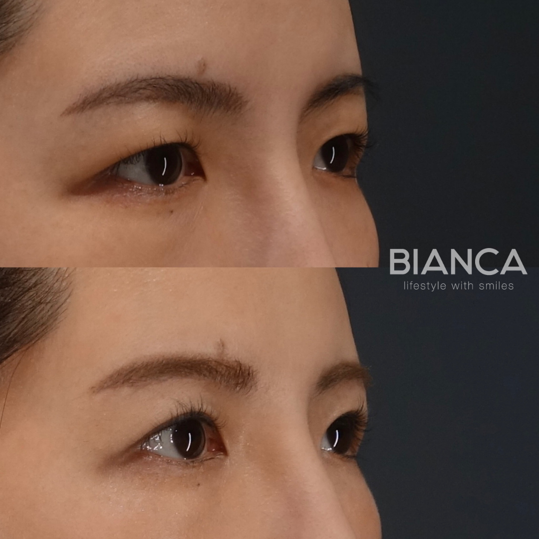 目が開きやすくなる眉下切開