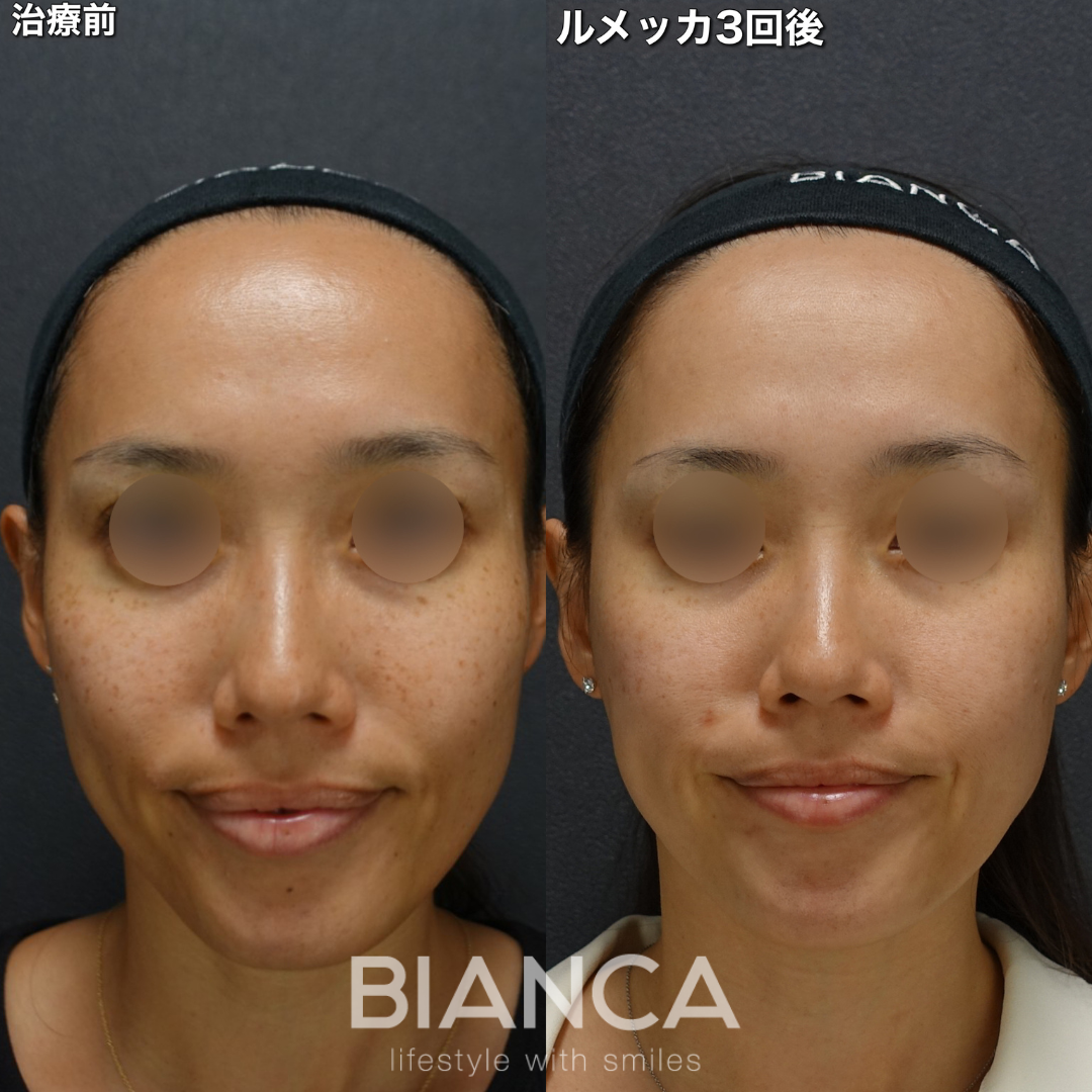 ルメッカで美肌に