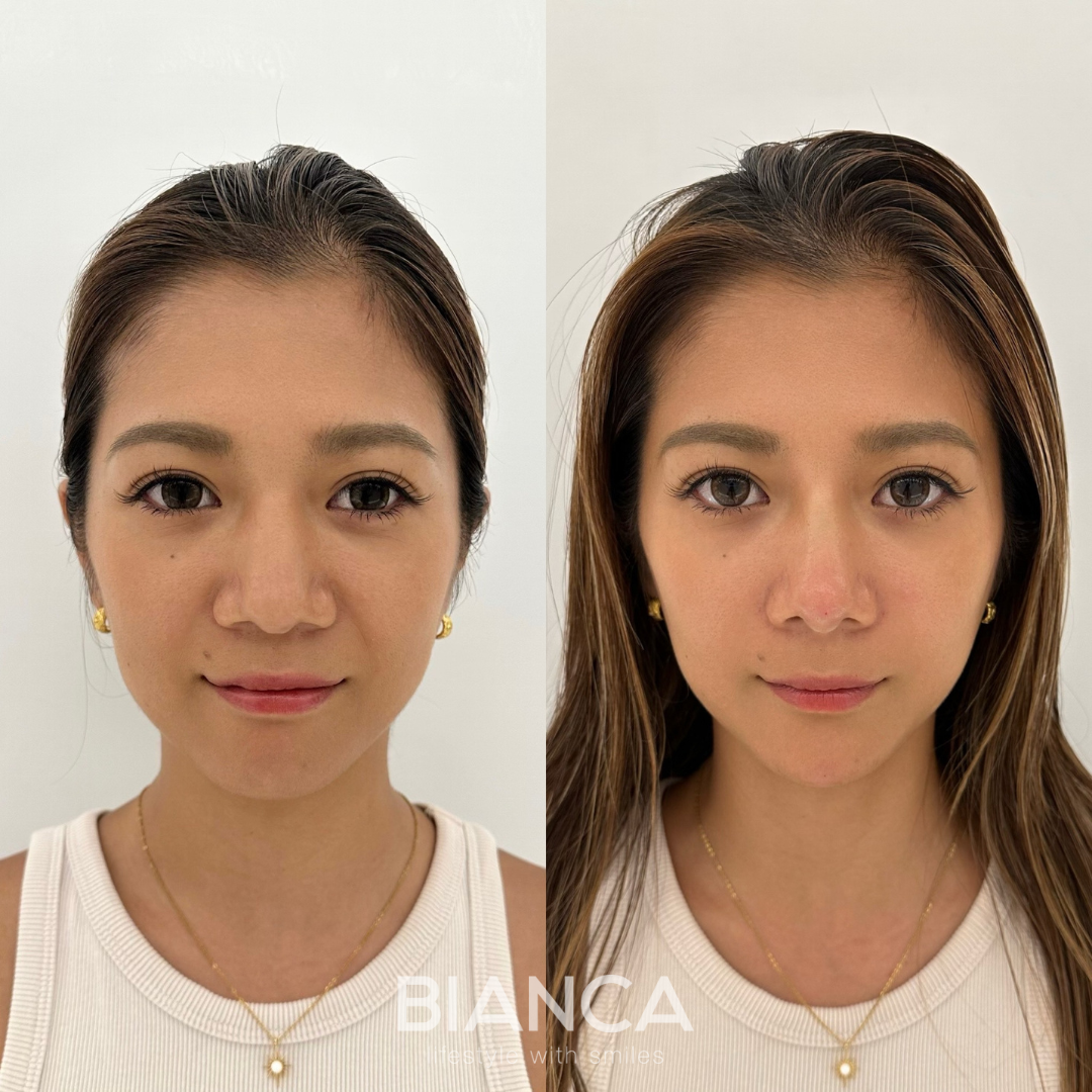 ヒアルロン酸で口元を整えて綺麗なバランスに