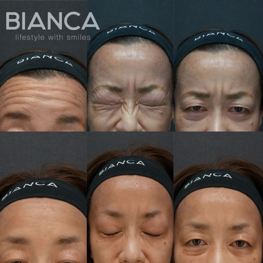 ボトックス注射（額・眉間・目尻・バニーライン）