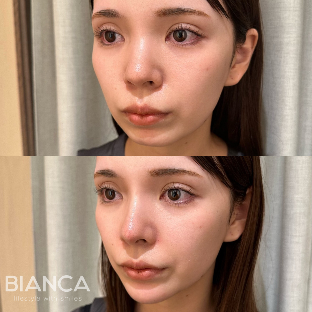 ヒアルロン酸で口元のバランスを整えて自然な垢抜け