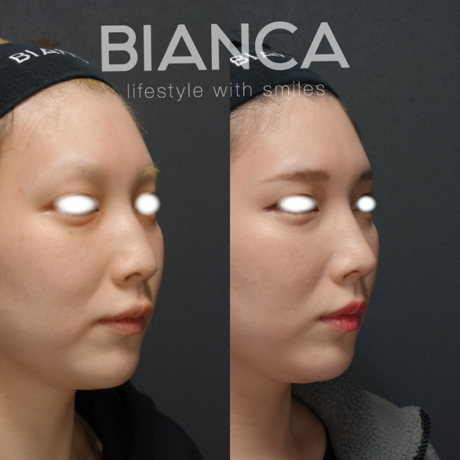 BIANCA RHINOPLASTY