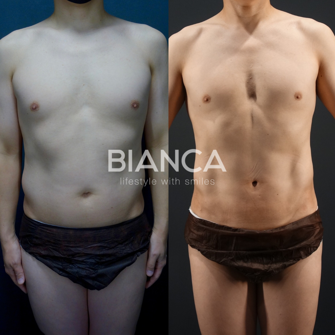 男性のアブクラックス形成