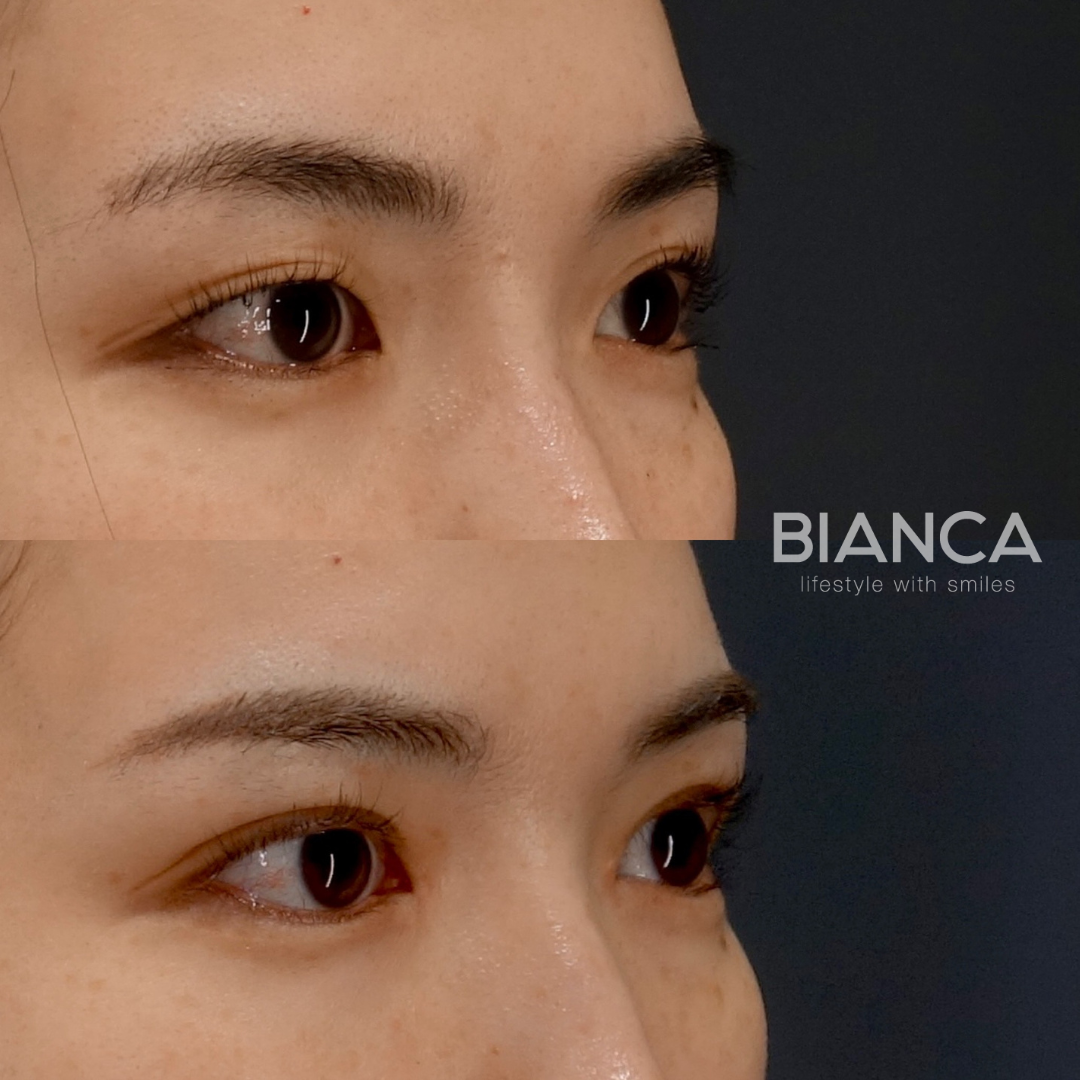 埋没法＋目頭切開で美しい二重ライン