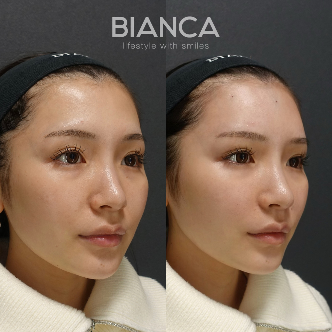 ヒアルで理想の美に