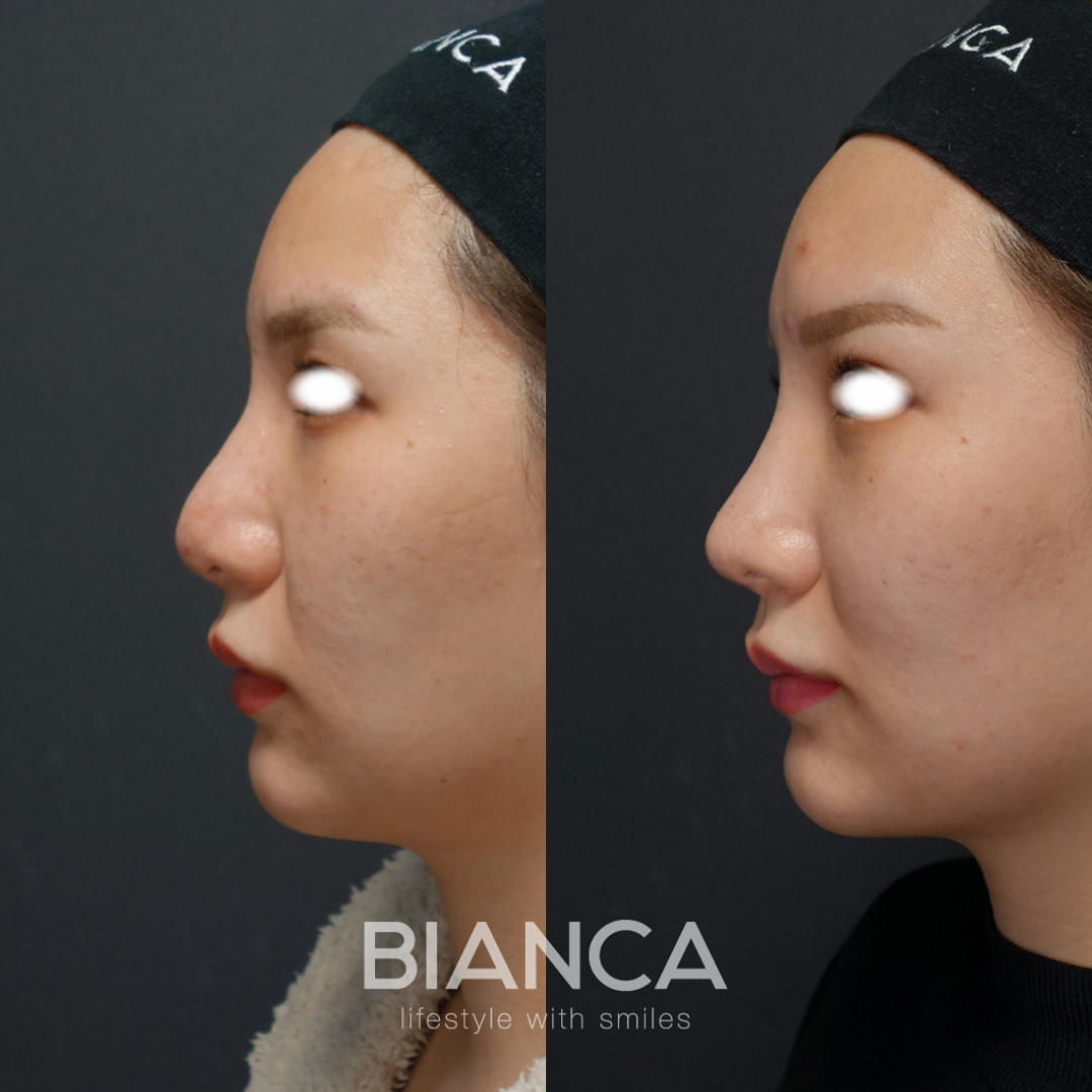 BIANCA 他院修正外来