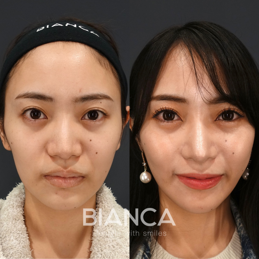 鼻整形＋小顔整形でお顔全体がシュッとして、かなり垢抜け
