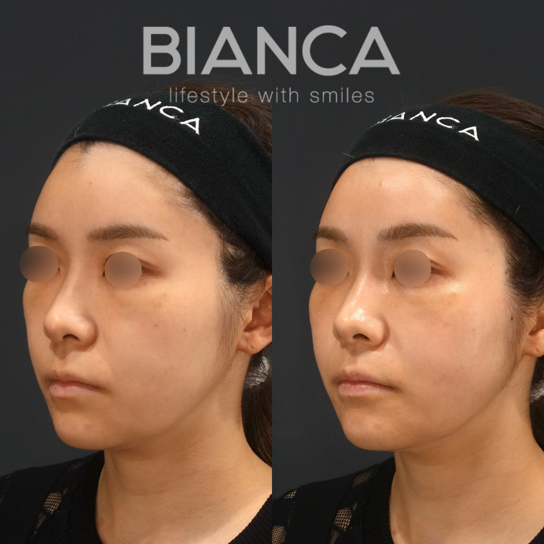 BIANCA LIFT　施術後