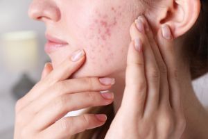 ニキビを皮膚科でどう治す？外用薬・内服・栄養サポートで整える大人の肌【医師監修】