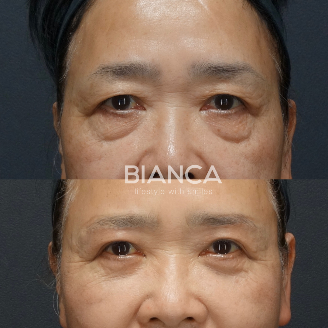 BIANCAの若返り企画