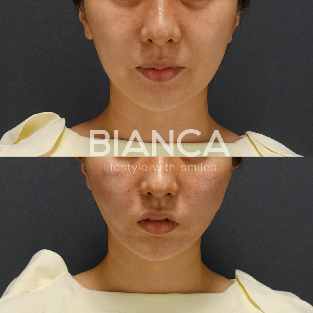 BIANCA LIFT×ショッピングリフト  直後