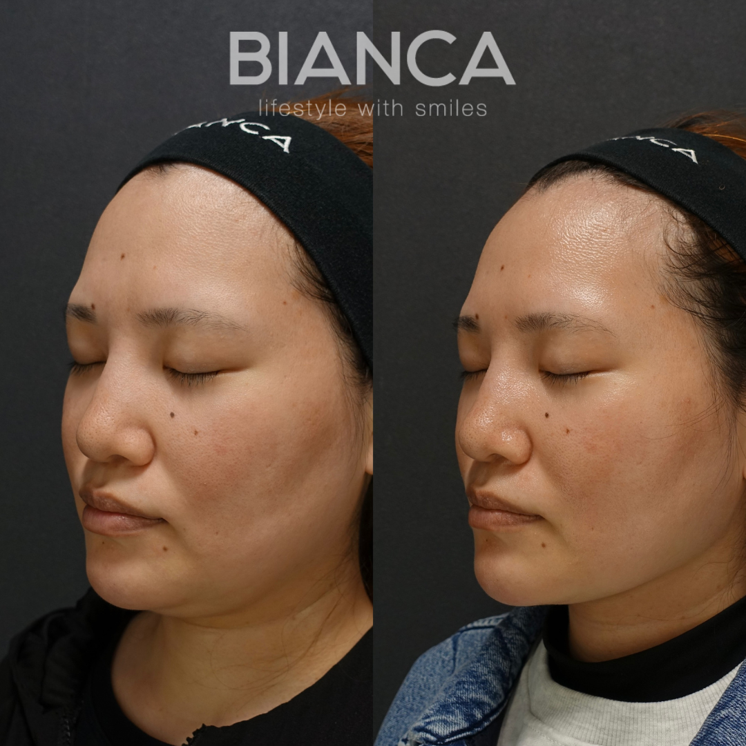 フェイスライン頬(顎下)脂肪吸引×BIANCALIFT6本　術後１カ月