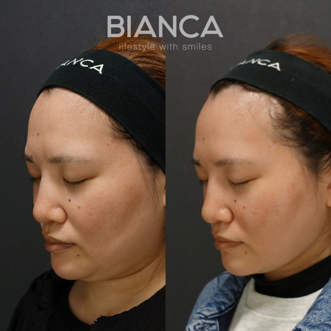 脂肪吸引（頬顎下）×BIANCA LIFT 10本　術後１カ月