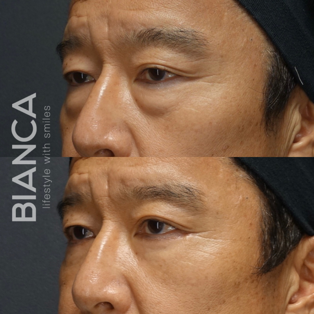 男性のクマ治療