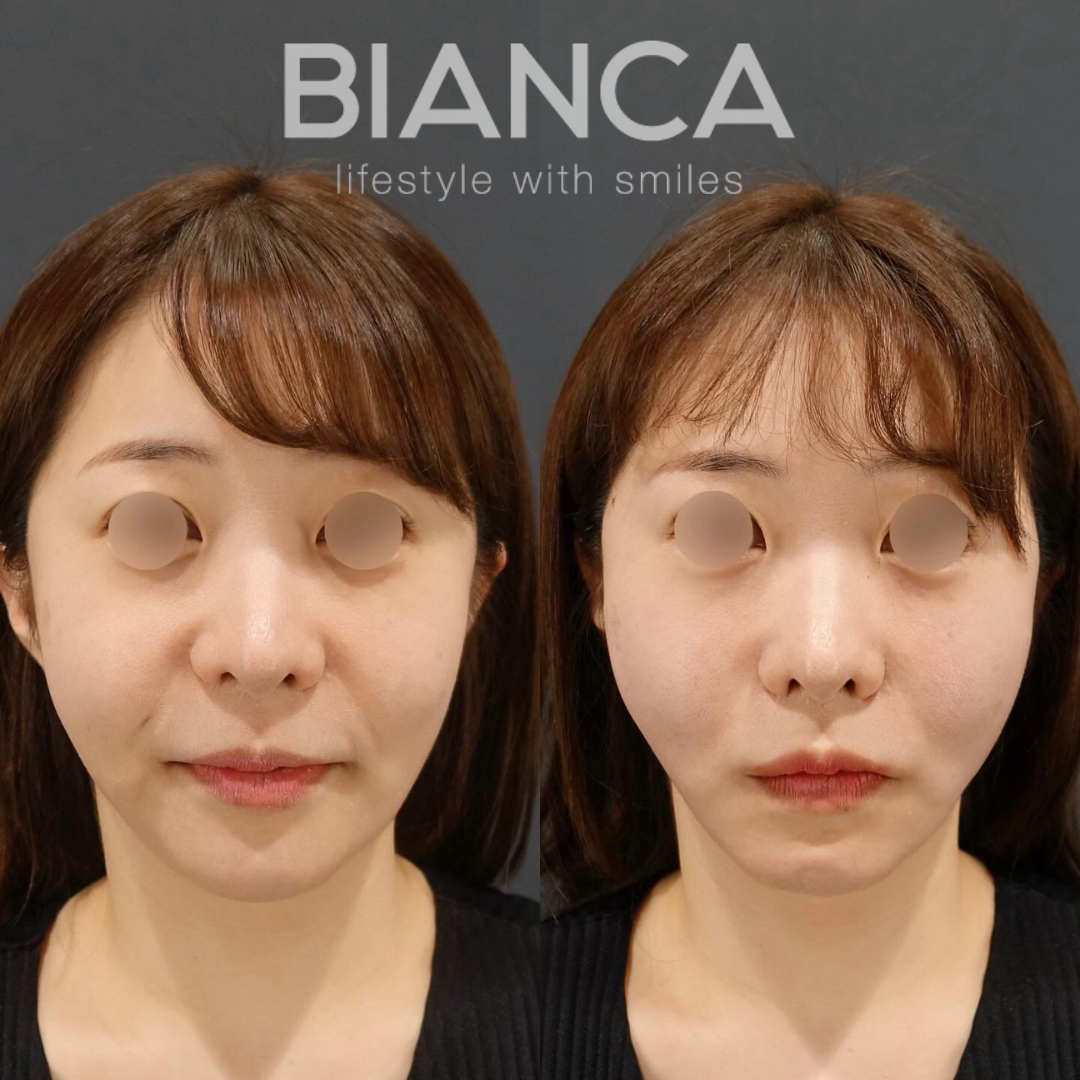 糸リフトメンテ