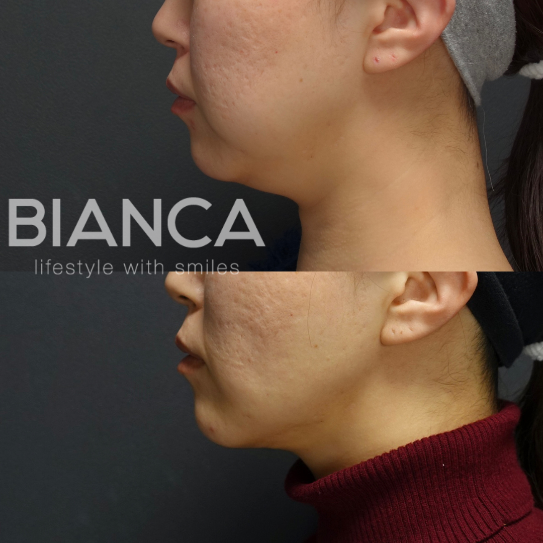 フェイスライン（頬顎下）脂肪吸引×バッカルファット×メーラーファット除去×BIANCA LIFT 10本　術後３ヶ月