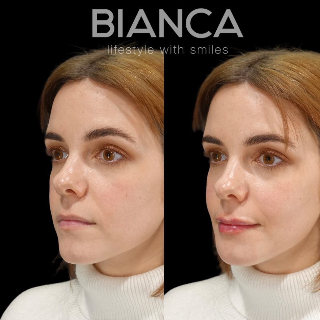 lip fillers