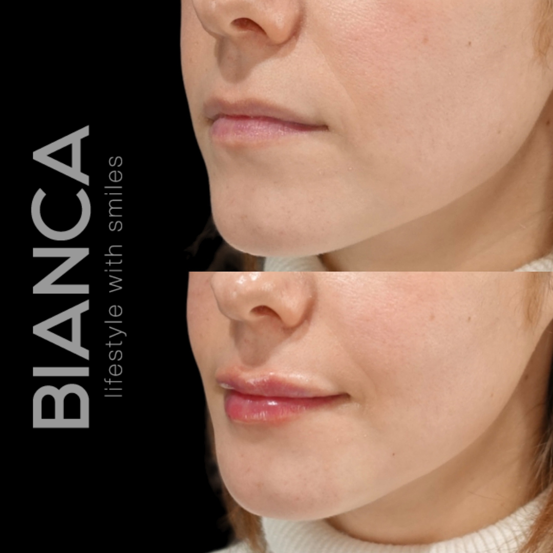 lip fillers