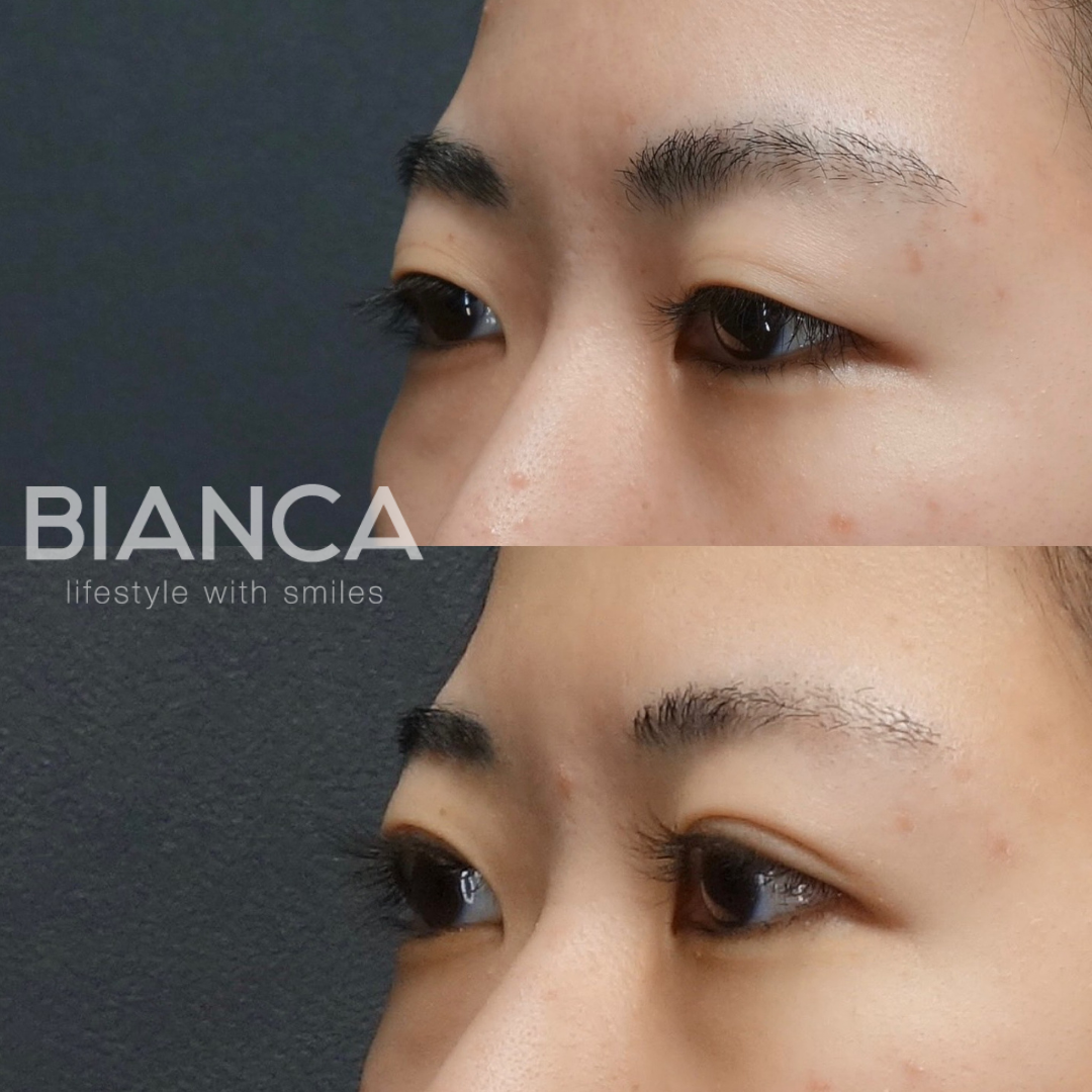 二重埋没法4点留め　術後３ヶ月