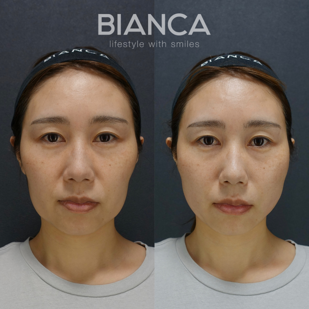 BIANCALIFT 4本　施術直後