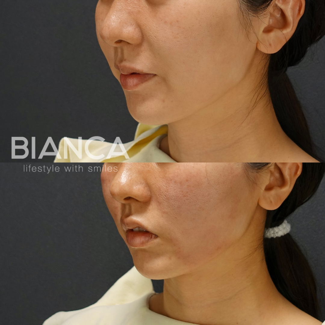 BIANCALIFT10本 ×MINI LIFT40本　施術直後