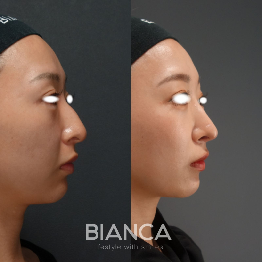 横顔をすっきり Preservation rhinoplasty