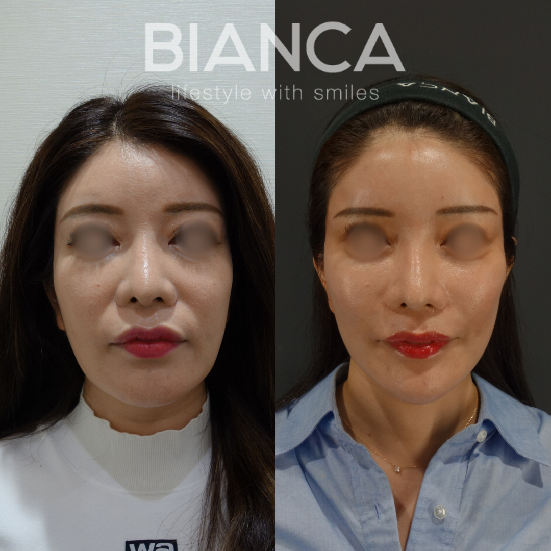 Deep plane facelift