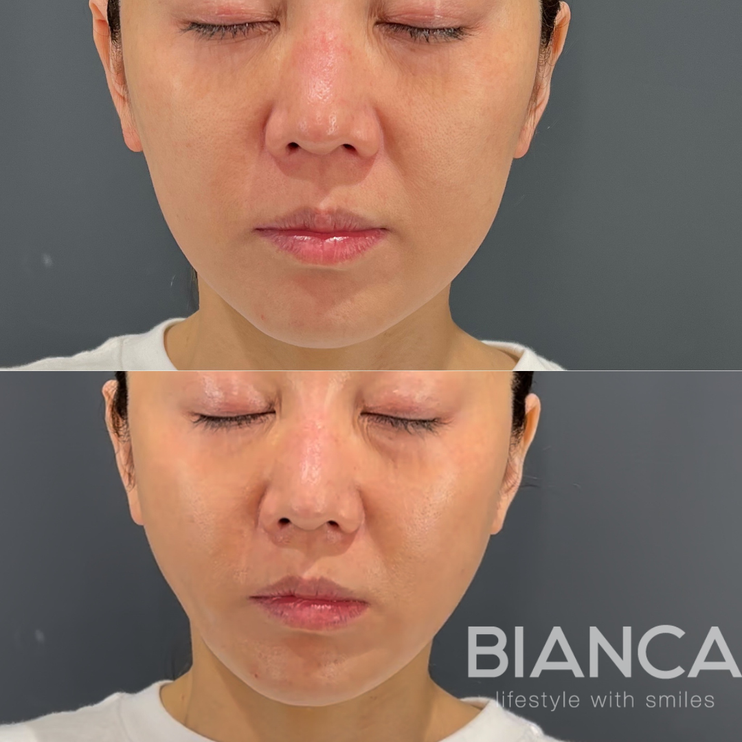 BIANCA リフト