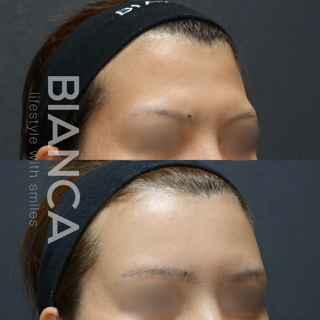 額 脂肪注入